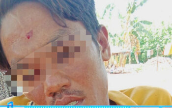 Ket Gambar : Korban inisial SRY (32) saat menunjukkan luka di bagian wajahnya.